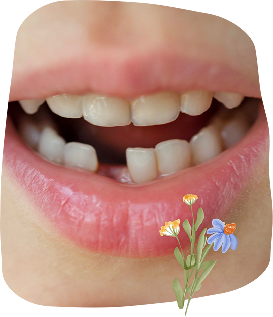 Close up of a child's smile with one missing lower tooth