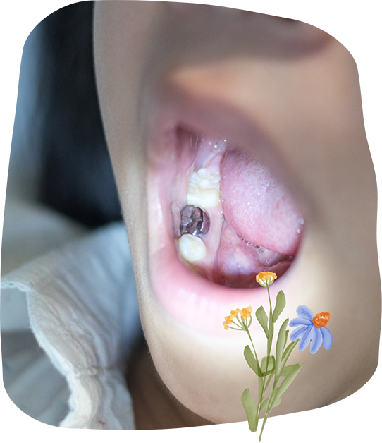 Close up of a child's mouth with a metal filling in one tooth