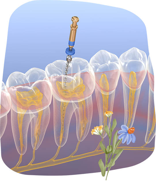 Illustration of a thin dental instrument treating the center of a tooth