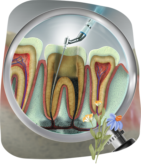 Illustration of a thin instrument treating a tooth's pulp