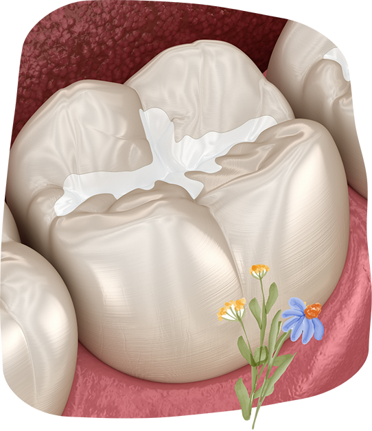 Illustration of a tooth with a white filling